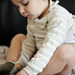 Kinderkrankheit Windpocken: Gesundheitsamt empfiehlt Impfung. Foto: S.Kobold/stock.adobe.com